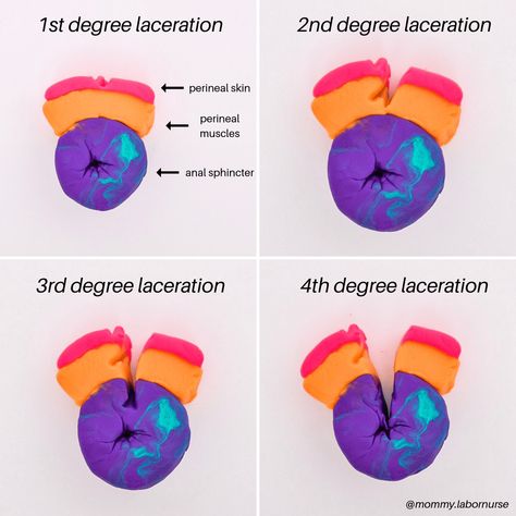 Episiotomy Vs. Tearing: Do You Know Which One is Better? How To Avoid Tearing During Labor, Labor And Delivery Nurse Education, Labor And Delivery Nursing, Nursing Instructor, Newborn Nursing, Midwifery Student, Postpartum Nursing, Ob Nurse, Student Midwife