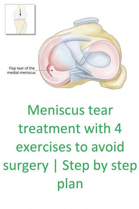 #KneePainSupport Meniscus Root Tear Recovery, Torn Medial Meniscus Exercises, Meniscus Surgery Recovery, Knee Meniscus, Meniscus Surgery, Exercises For Knee Pain, Knee Pain Relief Remedies, Knee Workout, Knee Pain Relief Exercises