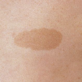 These flat patches on the skin can range in color from beige (coffee with a lot of milk) to light brown (coffee with a touch of milk). Brown Patches On Skin, Spots On Skin, Tuberous Sclerosis, Brown Spots On Skin, Best Face Serum, Turmeric Vitamins, Brown Spots Removal, Brown Spots On Face, Skin Spots