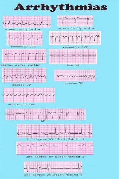 Nursing Cardiac Dysrhythmias Cheat Sheet Cardiac Nursing Cheat Sheets, Nursing Cardiac, Cardiology Nursing, Ekg Interpretation, Nursing Cheat Sheet, Ecg Interpretation, Paramedic School, Nursing School Essential, Nursing Mnemonics