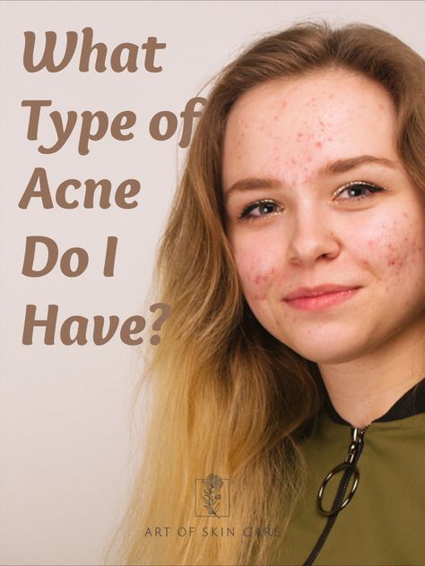 What Acne In Different Places Means, Pimple Under The Skin, Comedonal Acne, Clearing Acne, Different Types Of Acne, Acne Medicine, Blind Pimple, Mild Acne, Pimples Under The Skin