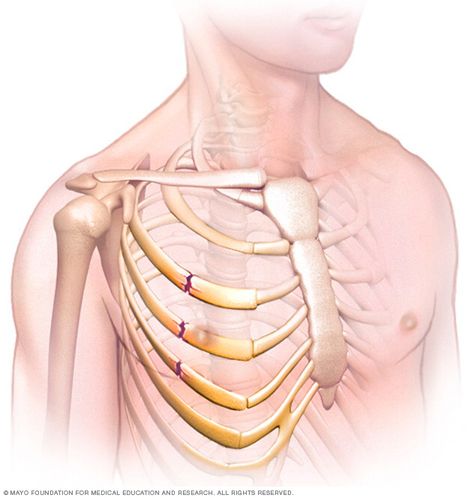 broken ribs Bone Fracture, Broken Ribs, Respiratory Infection, Rib Bones, Mayo Clinic, Chest Pain, Health Guide, Healing Process, Healing