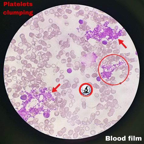 #blood film #blood smear #hematology #platelets clumping youtube.com/@Lab_Medicine1 May 27, Film, On Instagram, Pins, Instagram