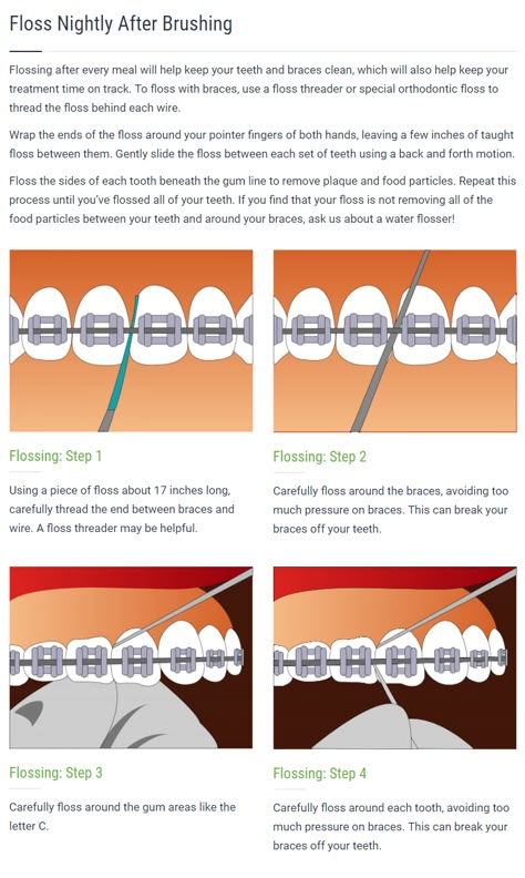 How To Floss With Braces, Braces Routine, Floss Threader, Teeth After Braces, Braces Journey, Cleaning Braces, Braces Care, Braces Ideas, Braces Food