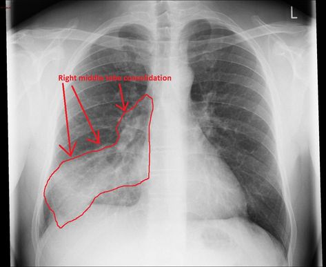 Pneumonia chest x ray - wikidoc Pleural Effusion, Breath Sounds, Urgent Care, Cute Love Couple Images, X Ray, Home Remedies, Natural Remedies