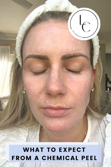 Chemical Peel Aesthetic, Chemical Peel Before And After, Chemical Peel Benefits, Jessner Peel, Chemical Face Peel, Glycolic Peel, Types Of Facials, Aesthetic Dermatology, Face Peel