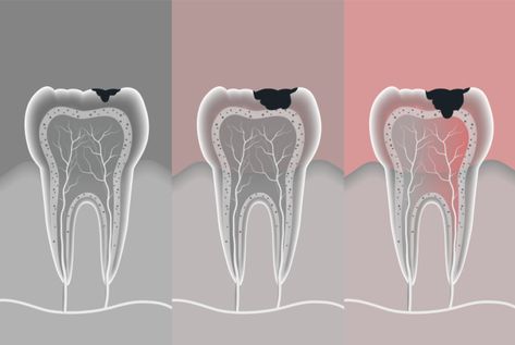 Holistic Teeth Healing, Teeth Reflexology Guide, Healing Teeth Naturally, Natural Dental Care, Diy Cavity Repair, Herbs For Dental Health, Healing Cavity Naturally, Natural Cavity Repair, Healing Cavities