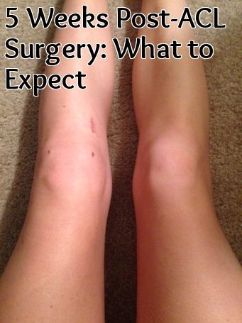 ACL Post-Surgery Week 5 - what to expect, recovery, and physical therapy! Acl Pt Exercises, Acl Surgery Recovery Tips, Knee Surgery Recovery Tips, Acl Recovery Exercises, Acl Recovery Timeline, Torn Acl Exercises, Post Acl Surgery, Acl Exercises, Meniscus Surgery Recovery