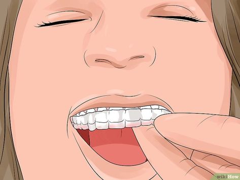 Tips For Getting Braces Off, What To Do When You Get Your Braces Off, What To Do Before Getting Braces, Braces Off Gift Basket, Getting Braces Off, How To Make Braces, Braces Removal, Teeth After Braces, After Braces