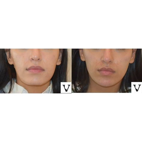 Want that sculpted, defined jawline? ✨ I can help! Jaw Augmentation is my passion, and the results are jaw-dropping. 😉 My clients experience amazing benefits like enhanced facial harmony, achieving a more balanced and aesthetically pleasing facial structure. They also enjoy youthful contours, restoring a youthful appearance by tightening and lifting the jawline. It’s a great confidence boost, helping them feel more confident and empowered with a strong, defined profile. And the best part? T... Facial Harmony, Defined Jawline, Facial Structure, Feel More Confident, Client Experience, Confidence Boost, My Passion, Aesthetically Pleasing, Facial