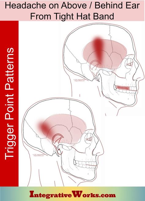 Headache Above/ Behind Ear Wearing Hat - Integrative Works Tooth Pain Remedies, Punkty Spustowe, Lump Behind Ear, Wisdom Teeth Pain, Tooth Pain Relief, Forward Head Posture Exercises, Relieve Neck Pain, Anatomy Medical, Neck And Shoulder Muscles