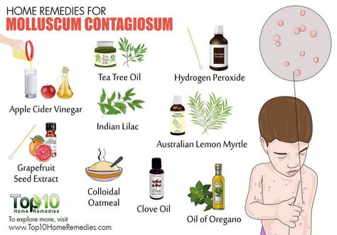 home remedies for Molluscum Contagiosum #Ailments #SelfCare #Home #HealthTips #Remedies #NutritionTips #Natural #Solutions #for #Common Molluscum Contagiosum, Top 10 Home Remedies, Grapefruit Seed Extract, Oil Remedies, Clove Oil, Natural Healing Remedies, Home Health Remedies, Natural Health Tips, Young Living Oils