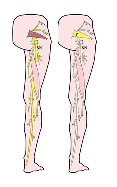 Sciatica and piriformis syndrome are similar in that they are both issues involving the sciatic nerve but also very different. There are many possible reasons for the onset of sciatic pain. In many cases something is pressing on the sciatic nerve—most often a slipped or herniated disc. These are the discs that live in between ... Sciatic Nerve Exercises, Nerve Relief, Sciatic Nerve Relief, K Tape, Inner Knee Pain, Piriformis Muscle, Sciatica Exercises, Piriformis Syndrome, Sciatica Relief