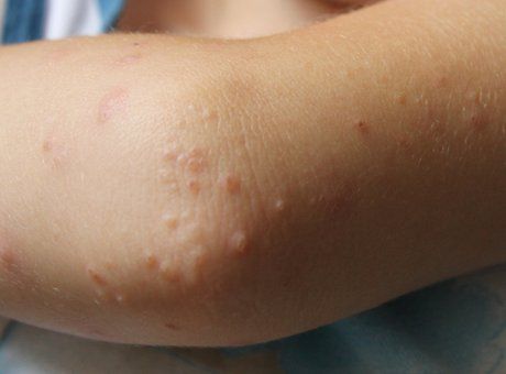 Small Raised Bumps on Elbows: Causes and Prevention | IYTmed.com Bumps On Elbows, Heat Bumps, Bumps On Arms, What Causes Pimples, Small Pimples, Dry Elbows, Blind Pimple, Pimples Under The Skin, Itchy Rash