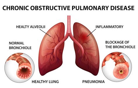 Nclex Practice Questions, Home Remedies For Bronchitis, Arterial Blood Gas, Nclex Questions, Lung Conditions, Lung Transplant, Test Plan, Healthy Lungs, Chronic Obstructive Pulmonary Disease