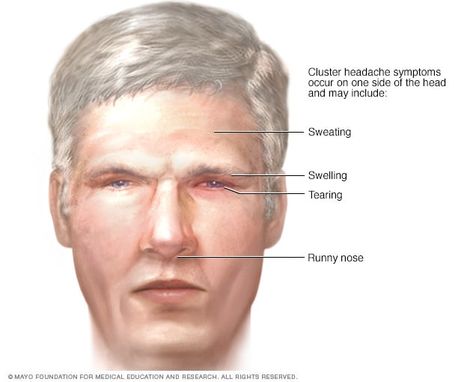 Cluster headache - Symptoms and causes - Mayo Clinic Cluster Headache, Headache Causes, Migraine Pain, Prevent Constipation, Severe Headache, Brain Cells, Mayo Clinic, Signs And Symptoms, Lifestyle Changes