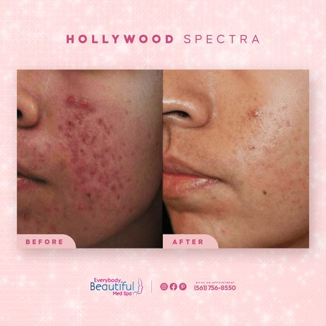 ✅ Resurface your skin from acne and scars with Hollywood Spectra. The heat generated from the laser removes a top layer of skin where scars form. This creates smoother appearing skin. ✨ Hard to believe? Check it out by yourself with this before and after 😍 ☎ Call Us Now: (561) 756-8550 📍 2499 Glades Rd #202, Boca Raton, FL 33431, United States 💻 Our Site: https://ebbmedspa.com/ We speak English 🇱🇷, Spanish 🇪🇸 and Portuguese 🇧🇷 Speak English, Layers Of Skin, Med Spa, Speaking English, The Heat, Check It Out, Spa, Hollywood, Acne