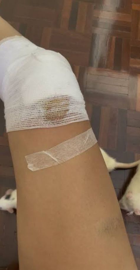 Leg Injury Insta Story, Fake Injury Leg Snapchat, Leg Fracture Snapchat Story, Arm Injury Fake Story, Fake Bandage Snap, Knee Wound Fake Story, Leg Wound Fake Story, Injury In Leg, Broken Leg Snapchat Story