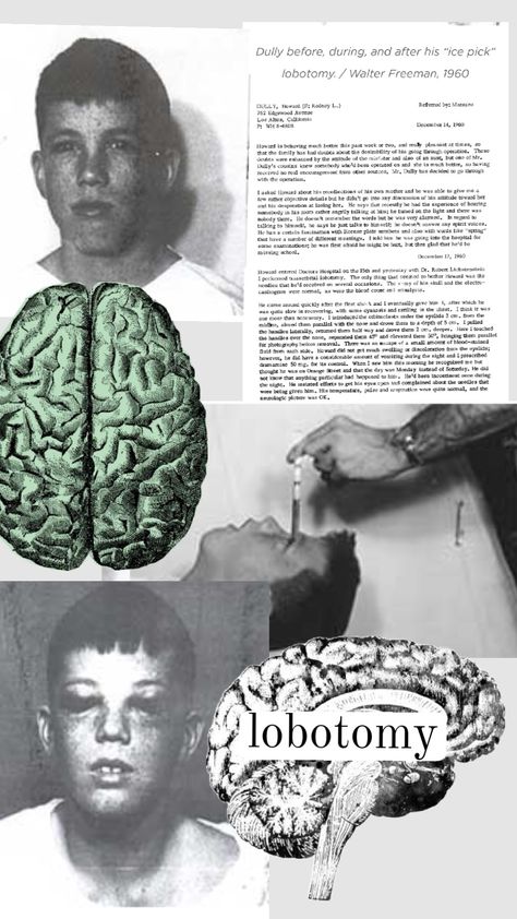 Howard Dully was one of the youngest patients to receive an “ice pick” lobotomy. He was 12. Lobotomy Aesthetic, Ice Pick, Pins