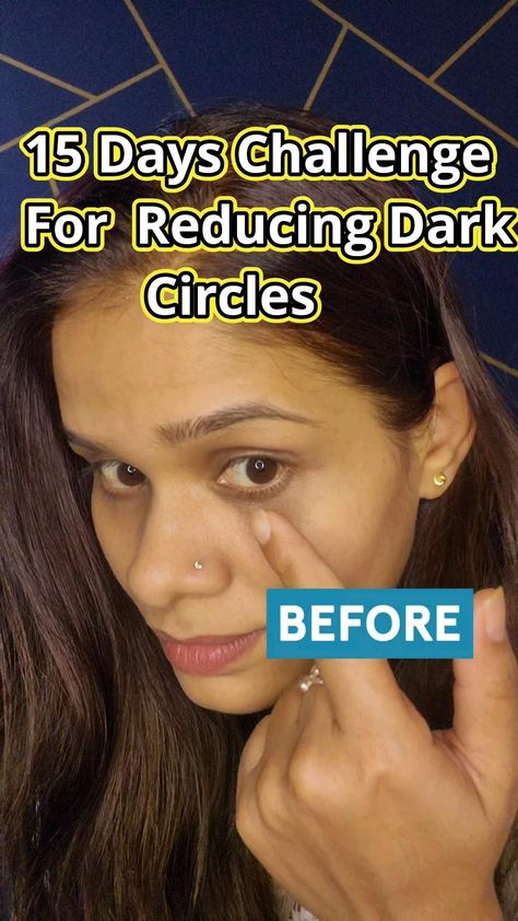 💪🏻15 Day Challenge for Under Eye Dark Circle Reduction Potato and Honey #shorts #darkcircles Eye Bag Remedies, Dark Circle Remedies, Dark Circles Around Eyes, Honey Beauty, Dry Skincare, 15 Day Challenge, Dark Eye Circles, Natural Face Skin Care, Good Skin Tips