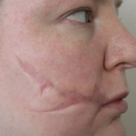 Burn Mark Drawing Reference, Ww1 Facial Injuries, Burnt Skin Aesthetic, Pretty Birthmarks, Scars On Face Reference Drawing Reference, Draw Burn Scars Reference, Human Snarling Reference, Human Branding Skin, Cheek Scar Reference