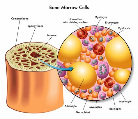 Bone marrow cells. Medical illustration of the composition of bone marrow cells , #AFFILIATE, #cells, #marrow, #Bone, #Medical, #bone #ad Myeloproliferative Neoplasms, Pediatric Oncology, Blood Disorders, Pelvic Bone, Cord Blood Banking, White Blood Cells, Bone Marrow, Blood Cells, Bone Health