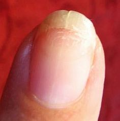 Here's how to repair split fingernails--try it, it really works! Split Nail Repair, Fingernail Health, Nail Ridges, Fix Broken Nail, Nail Remedies, Split Nails, Peeling Nails, Nails Care, Natural Detergent