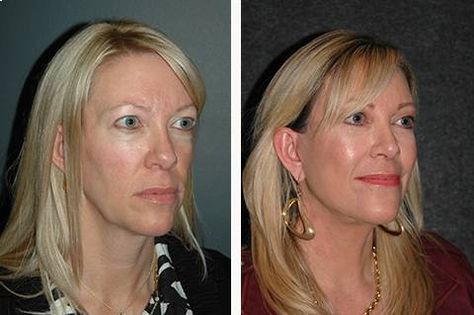 Mini Facelift Before & After Photos | Dr. Andrew Jacono Endoscopic Brow Lift, Mini Face Lift, Facelift Before And After, Sagging Cheeks, Facelift Procedure, Chin Augmentation, Laser Skin Resurfacing, Face Lift Surgery, Natural Face Lift