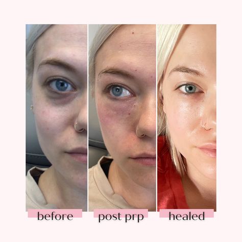 Under Eye Prp Before And After, Lip Line Tattoo, Tear Through Filler Before And After, Under Eye Botox Before And After, Tear Trough Filler, Eye Fillers Before And After, Eye Trough Filler Before And After, Collagen Benefits Before And After, Undereye Filler Before And After