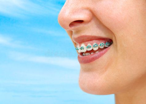 Turquoise Braces. Detail of young woman smile showing white teeth with braces , #SPONSORED, #young, #woman, #Detail, #Turquoise, #Braces #ad Turquoise Braces, Types Of Braces, Teeth Whitening Remedies, Teeth Whitening Gel, Charcoal Teeth Whitening, Teeth Whitening System, Dental Braces, Emergency Dentist, Best Teeth Whitening