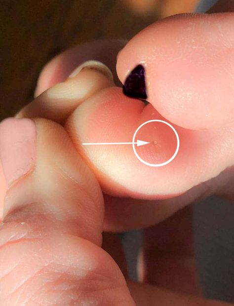 Plantars Wart Remedy, Diy Wart Removal Fast, Planters Warts On Foot, Plantar Wart Removal Videos, How To Get Rid Of Warts On Hands, Plantar Warts How To Get Rid Of, Warts How To Get Rid Of, Wort Removal, Planter Warts Remedies