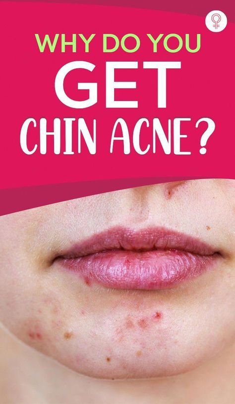 Chin Acne, Back Acne Remedies, Blind Pimple, Pimples Under The Skin, Forehead Acne, Bad Acne, Acne Overnight, Prevent Pimples, Natural Acne Remedies