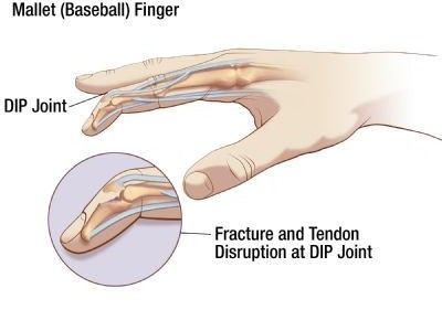 What is mallet finger, and how can you treat it? From Oh My Arthritis Nbcot Exam Prep, Finger Illustration, Nbcot Exam, Anatomy 101, Mallet Finger, Physical Therapy School, Finger Injury, Finger Splint, Emotion Chart