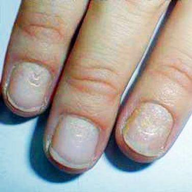 Watch out for these changes to your fingernails. Lengthen Nail Beds, Fingernails Health Signs, Finger Nails Health, Nails Digging Into Skin, Dents In Nails, Pitted Nails, Hang Nail Remedy Infected Finger, Bumpy Nails, Nail Disorders