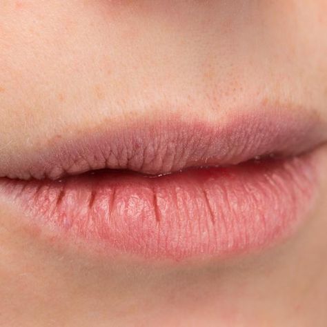 A crack in the skin; may or may not penetrate the dermis. Example: cracked lips or heels Cracked Lip Corners, Lips Cracked, Chapped Lips Aesthetic, Cracked Lips Aesthetic, Scar Face Aesthetic Lip, Cracked Lips, Cartoon Profile Pics, Beauty Secrets, Lip Makeup