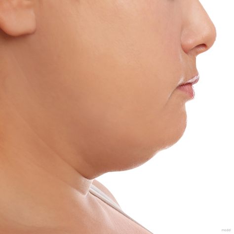 Got a double chin? Regardless of why and how much extra chin is distorting your face, you want it gone! The good news is we have solutions for you! Read our latest blog at the link below and learn surgical, nonsurgical, and minimally invasive options to get rid of it! Remove Double Chin, Tighten Loose Skin, Double Skin, Plastic Surgery Procedures, Excess Skin, Neck Lift, Cool Sculpting, Fat Removal, Fat Reduction