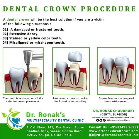 Dental Crown Procedure, Medical Items, Dental Assisting, Dental Crowns, Dental Assistant, Book An Appointment, Dental Health, Dental Care, Click The Link