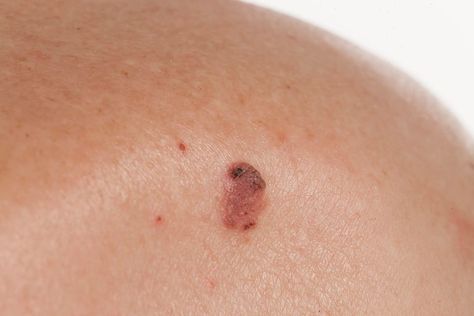 basal squamous cell carcinoma Seborrheic Keratosis, Skin Care Specialist, Squamous Cell, Mole Removal, Bumpy Skin, Natural Healing Remedies, Skin Spots, Orange County California, Skin Care Remedies