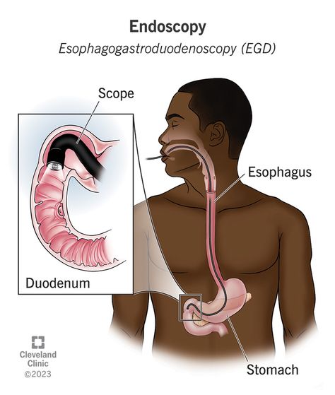 Endoscopy Procedure, Liver Care, Gastrointestinal Disease, Large Intestine, Cleveland Clinic, Urinary Tract, Respiratory System, Pregnancy Test, Digestive System