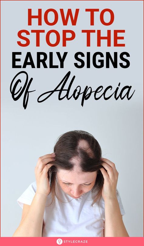 Alopecia Symptoms Signs, Hair Growth For Alopecia, Alopecia Diet Autoimmune Disease, How To Treat Alopecia, Bald Spots Women Remedies, Hairstyles For Alopecia For Women, Androgenic Alopecia In Women, Hairstyles For Balding Woman, Alopecia Diet