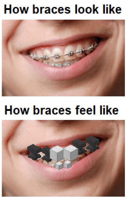 Braces Memes Funny, Braces Meme, Fun Quotes, Really Funny Joke, Fun Quotes Funny, Quotes Funny, Braces, Really Funny, Best Quotes