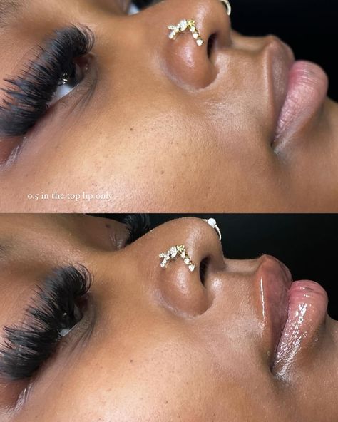 Have you tapped into our lash and lip combo?! This client got a full volume cat eye set with 0.5mL plumping in her top lip! 🫦 Why should you consider needless lip plumping??! READ BELOW ⬇️ Needleless lip plumping can help improve lip symmetry (as shown above) by allowing for precise and controlled application of the filler. Here’s how they work: 🫦 **Targeted Application**: The device used in needleless lip plumping typically delivers the filler in small, controlled bursts. This allows f... Needless Lip Filler, Volume Cat Eye, Juvederm Lips, Small Lips, Lip Filler, Lip Plumping, Full Volume, Lip Combo, Lip Fillers