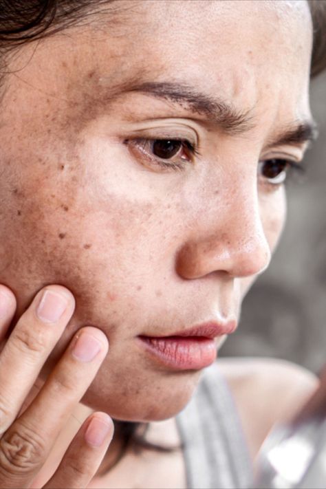 Hyperpigmentation can be extremely difficult to treat. In this post we discuss how combining Hydroquinone and Tretinoin can offer a potent solution to safely and effectively fade dark spots and even out skin tone. Pigmented Skin, Hyper Pigmentation, Hyper Pigmentation On Face, Skincare For Pigmentation, Best Skin Product For Hyperpigmentation, Faded Hyperpigmentation Cream, Dark Spots On Face, Remove Dark Circles, Fade Dark Spots