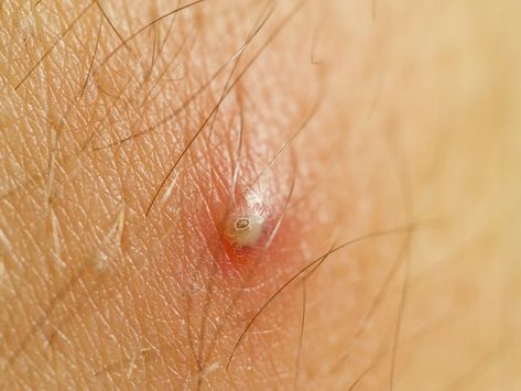 How to Get Rid of Ingrown Hair Ingrown Hair Under Armpit, Pulling Out Ingrown Hair, Infected Hair Follicle, Infected Ingrown Hair, Treat Ingrown Hair, Ingrown Hair Remedies, Ingrown Hair Removal, Nail Problems, Armpit Fat