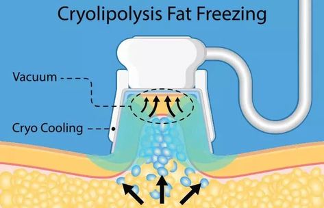 8 Best Fat Freezing Machines For A Sculpted Body – 2020 Coolsculpting Results, Freezing Fat Cells, Stomach Massage For Fat Loss, Visceral Fat Loss, Radio Frequency Skin Tightening, Skin Anatomy, Fat Freezing, Ultrasonic Cavitation, Beauty Skin Quotes