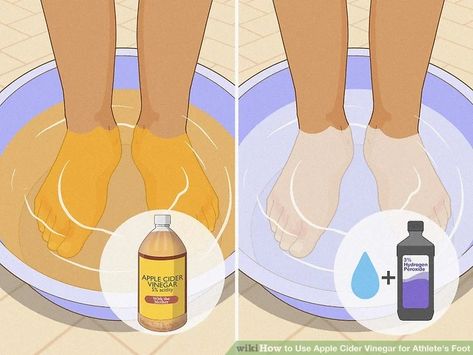 4 Ways to Use Apple Cider Vinegar for Athlete's Foot - wikiHow Apple Cider Vinegar Feet Soak, Yellow Toenails Remedy, How To Make Your Feet Not Stink, How To Get Rid Of Athletes Foot Fast, Athletes Foot Remedy How To Get Rid Of, Itchy Feet At Night, Itchy Feet Remedy, Athletes Foot Remedy, Smelly Feet Remedies