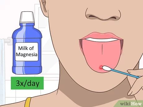 3 Ways to Heal a Tongue Ulcer - wikiHow Mouth Ulcers Causes, Mouth Ulcers Remedy How To Get Rid Of, Tounge Health Cracks, Mouth Ulcer, Ulcer On Tongue, Tongue Sores, What To Use, Dental Health, Diet And Nutrition