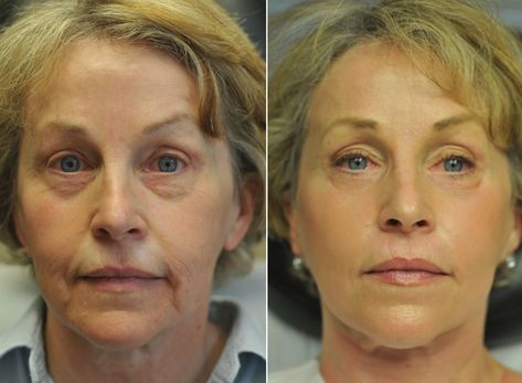 Fraxel Laser Before And After, Fraxel Laser, Celebs Without Makeup, Laser Resurfacing, Columbus Ga, Laser Skin, Cosmetic Procedures, Massage Techniques, Aging Gracefully