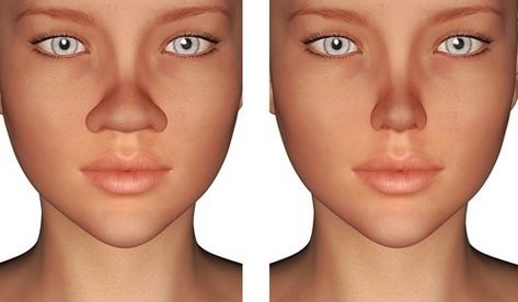 Rhinoplasty, more simply referred to as a nose job, is a plastic surgery procedure that by now, we have all ... Rhinoplasty Nose Jobs, Face Fillers, Facial Bones, Rhinoplasty Before And After, Rhinoplasty Surgery, Wide Nose, Pretty Nose, Beauty Procedures, Perfect Nose