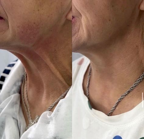 Botox for Platysmal Bands👇🏻  Treating platysmal bands with botulinum toxin leads to reduced appearance of the platysma muscles by simply relaxing the neck muscles.    Dm us or call for all the details 👇🏻 📱 (917) 701-0253  📞 (585)441-3838 📍1934A Williamsbridge Rd, Bronx, NY Platysmal Bands, Platysma Muscle, Neck Muscles, Botulinum Toxin, Botox Fillers, Bronx, The Details, Muscles, Medicine